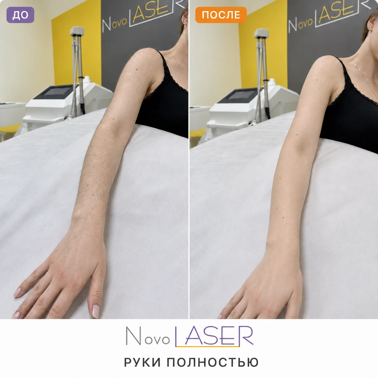 Руки полностью: сравнение до и после лазерной эпиляции, фото 9 NovoLASER