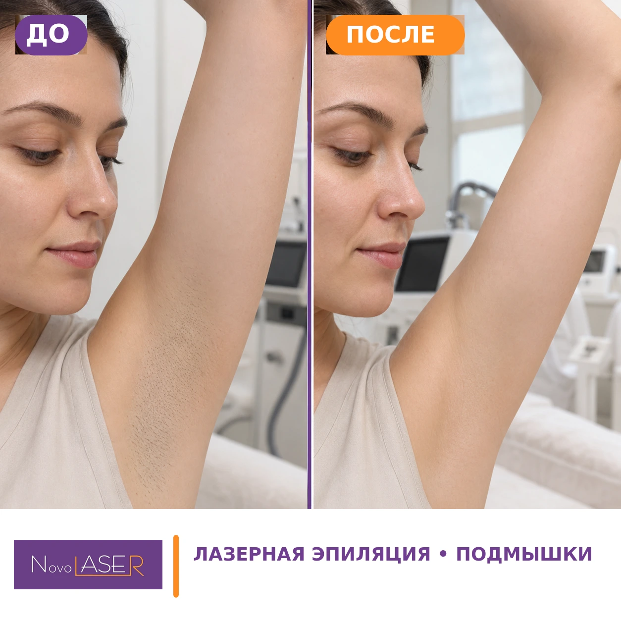 Подмышки: сравнение до и после лазерной эпиляции, фото 2 NovoLASER